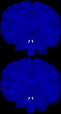 Automatic geometry-based estimation of the locus coeruleus region on T1-weighted magnetic resonance images